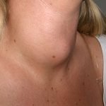 Ciri Gejala Hipertiroid